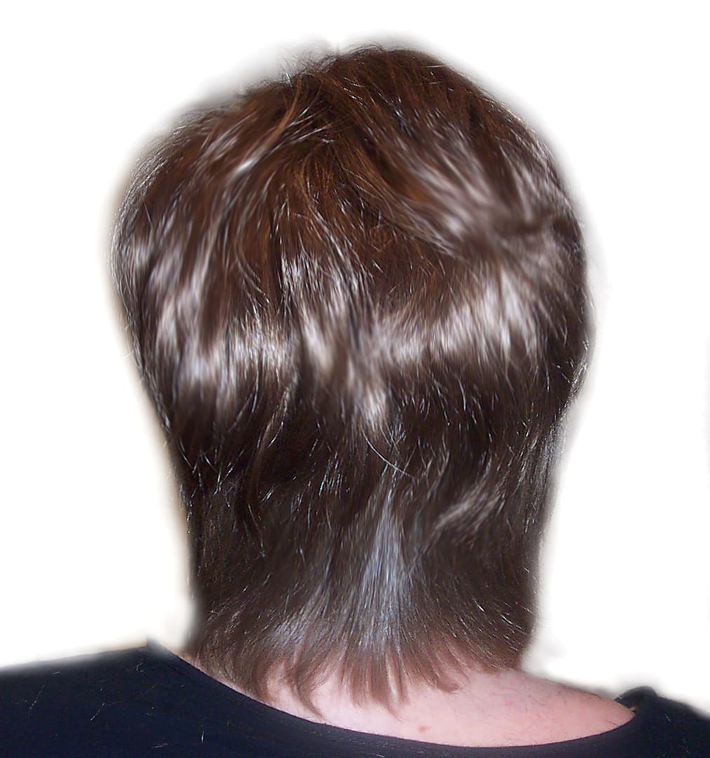After Picture - Trichotillomania & Full Recovery